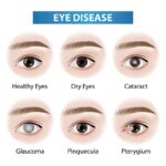 Eye Disorders